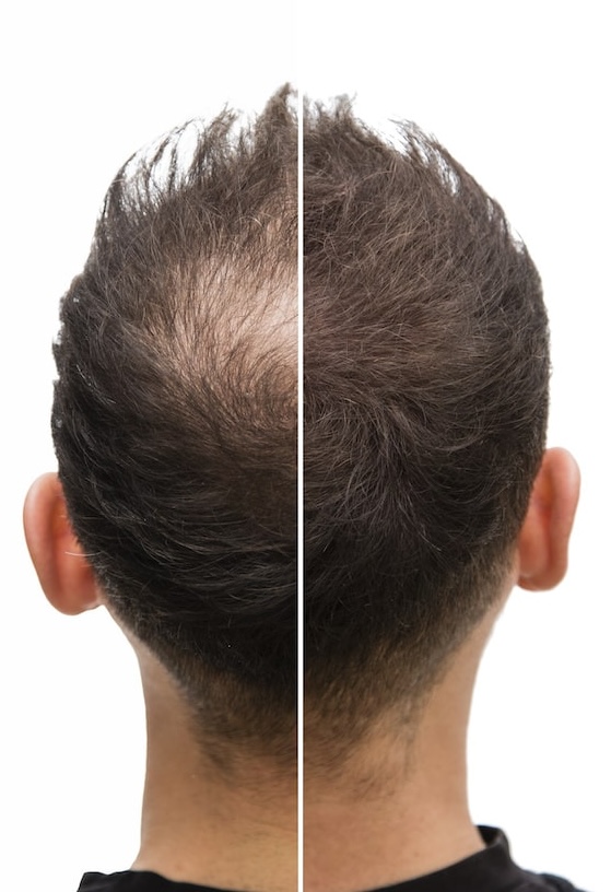 Nano Scalp Micropigmentation for Men